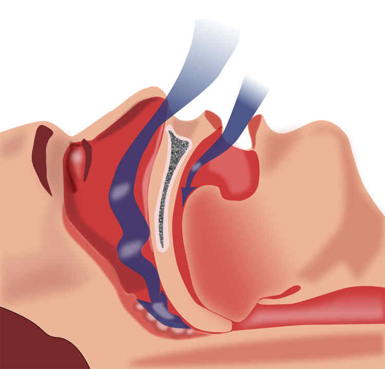 Sindrome delle apnee ostruttive nel sonno